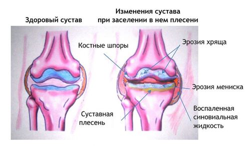 Рис. 3. Состояние здорового и заселенного плесенью коленного сустава