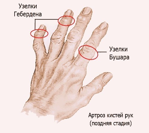 Рис. 4. Изменеия форм пальцев руки при артрозе