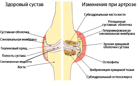 Рис. 2. Сравнение здорового и измененного артрозом коленного сустава